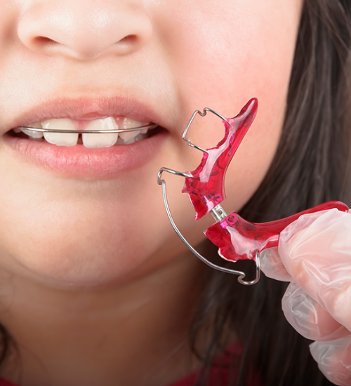 Orthodontie précoce et fonctionnelle dès 5 ans