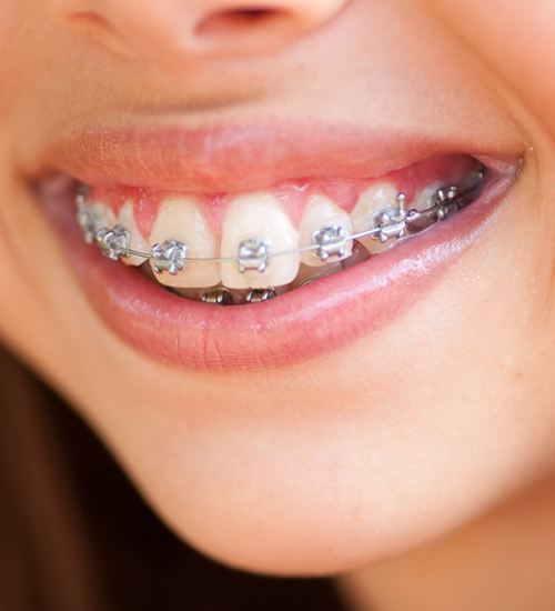 Orthodontie de l’adolescent